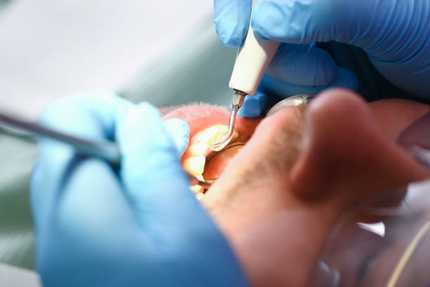Best Knocked-Out Tooth (Avulsed Tooth) Treatment in Bowie, MD